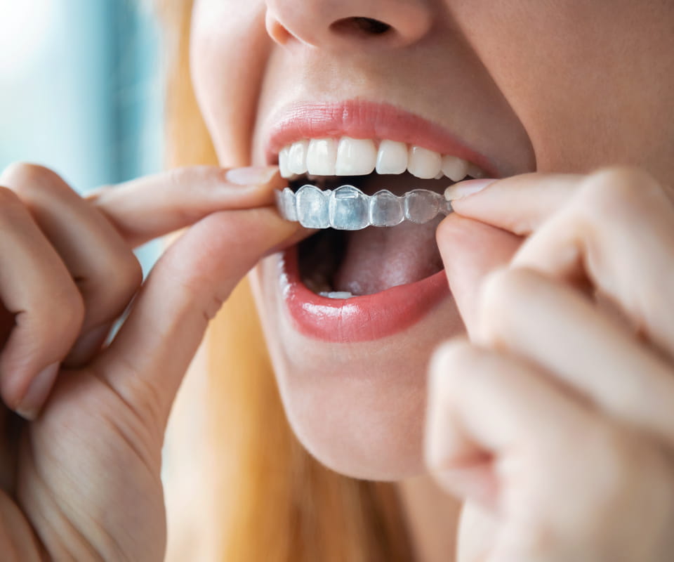 McKinney dentist Dr. Peter J. Kim provides Invisalign treatment at Pecan Tree Family Dentistry