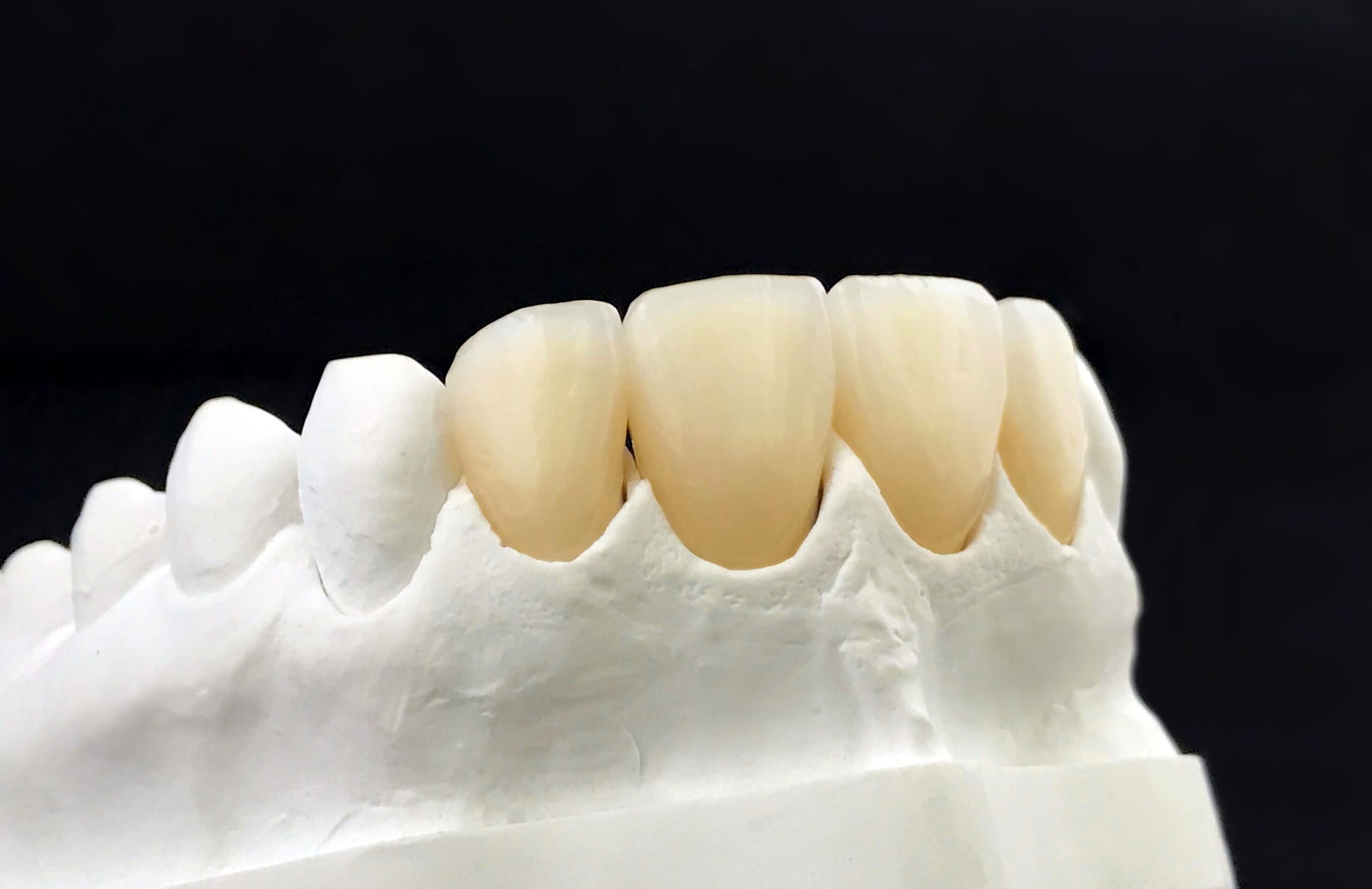 Close-up view of zirconia dental crowns in a white plaster model on a black background.